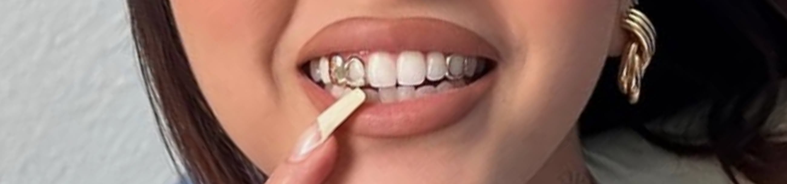 Gold single tooth cap with floral gem detail being fitted, close-up showing clean white teeth and gold hoop earrings