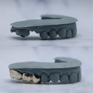 Custom silver bottom grillz fitted over front lower teeth on a dental cast with a missing premolar, shown before and after