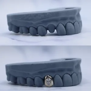 Custom pear-shaped diamond bezel crown on an upper canine tooth, shown before and after on a dental cast with a missing canine