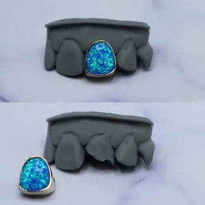 Custom blue-green opal bezel single-tooth crown for a missing upper canine, shown fitted on a dental cast and removed
