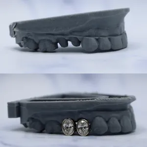 Two custom oval bezel-set diamond crowns fitted on the lower front teeth, shown before and after on a dental cast with missing bottom teeth