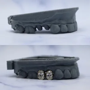 Pair of oval bezel-set diamond single-tooth crowns on the lower front arch, shown before and after on a dental cast